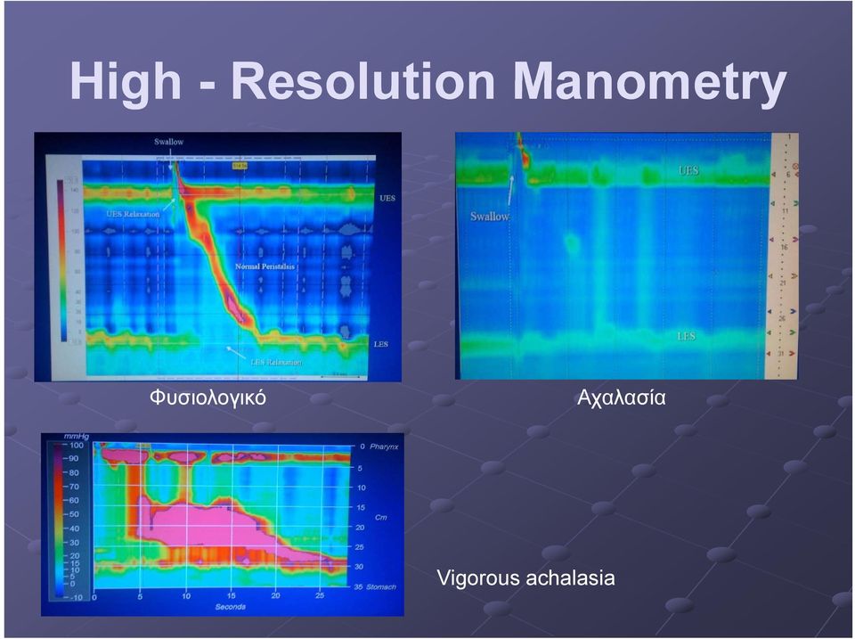 Manometry