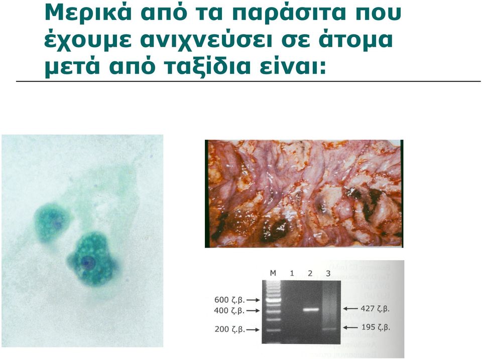 είναι: Entamoeba histolytica Πρόβλημα : η