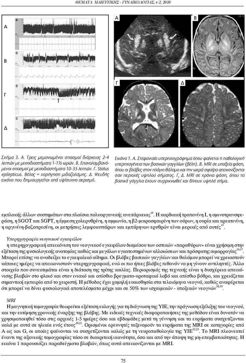 MRI σε υποξεία φάση, όπου οι βλάβες στον πλάγιο θάλαμο και την ωχρά σφαίρα απεικονίζονται σαν περιοχές υψηλού σήματος. Γ, Δ.