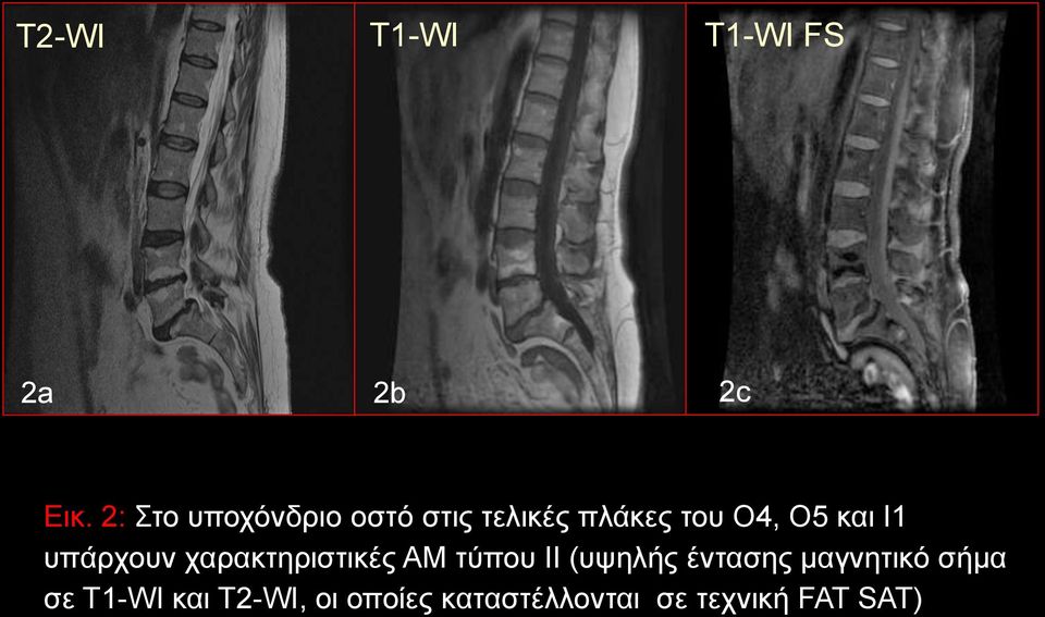 και Ι1 υπάρχουν χαρακτηριστικές ΑΜ τύπου II (υψηλής