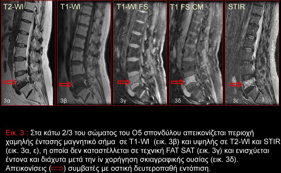 Τ1-WI (εικ. 3β) και υψηλής σε Τ2-WI και STIR (εικ.