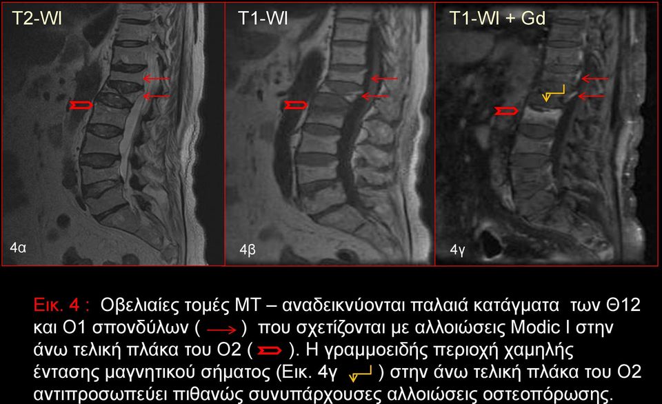 σχετίζονται με αλλοιώσεις Modic Ι στην άνω τελική πλάκα του Ο2 ( ).