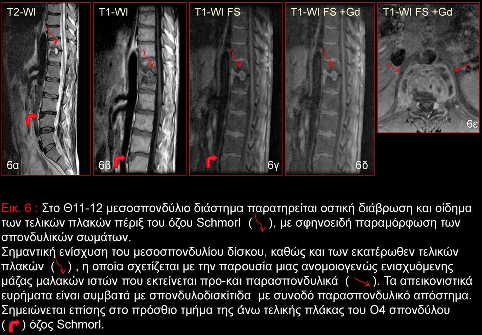 σπονδυλικών σωμάτων.