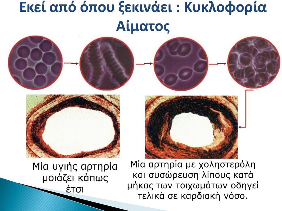 αρτηρία με χοληστερόλη και συσώρευση λίπους