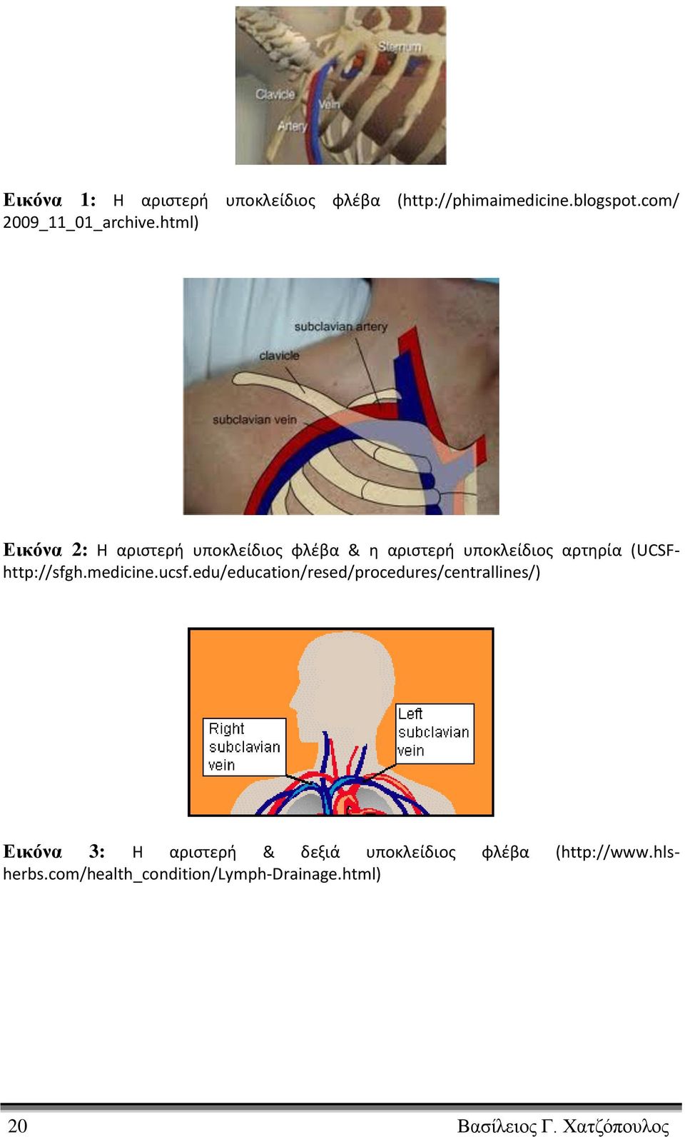 html) Εικόνα 2: Η αριστερή υποκλείδιος φλέβα & η αριστερή υποκλείδιος αρτηρία