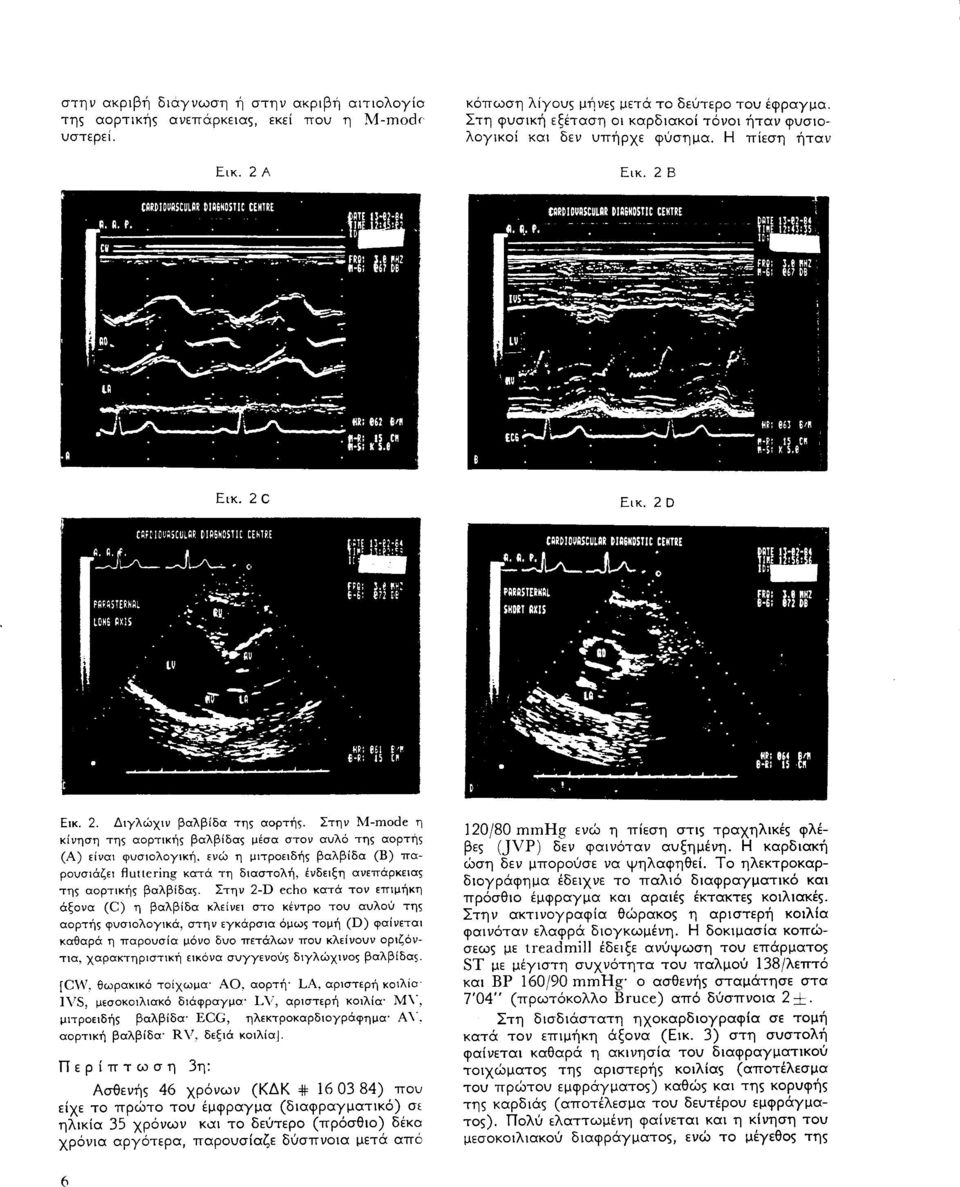 Στην M-mode η κίνηση τηι αορτικήι βαλβίδαι μέσα στον αυλό τηι αορτήι (Α) είναι φυσιολογική.