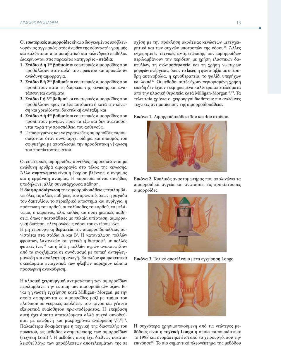 Στάδιο Β ή 2 βαθμού: οι εσωτερικές αιμορροΐδες που προπίπτουν κατά τη διάρκεια της κένωσης και ανατάσσονται αυτόματα. ου 3.