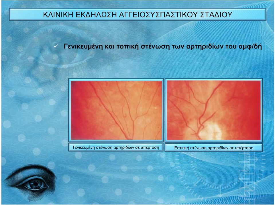 του αμφ/δή Γενικευμένη στένωση αρτηριδίων σε