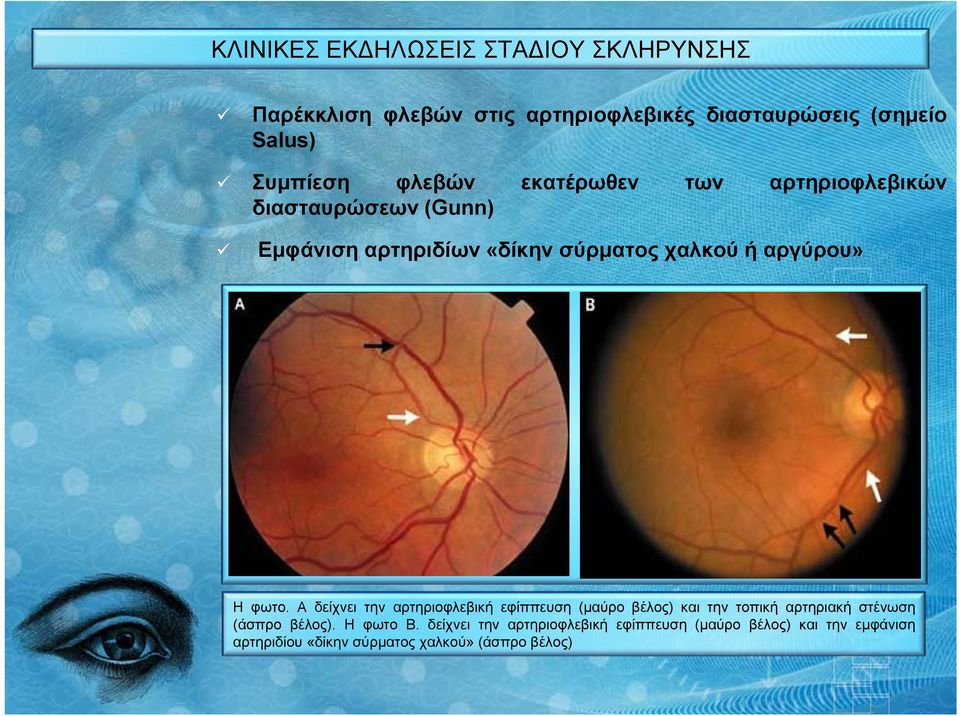 φωτο. Α δείχνει την αρτηριοφλεβική εφίππευση (μαύρο βέλος) και την τοπική αρτηριακή στένωση (άσπρο βέλος). Η φωτο Β.