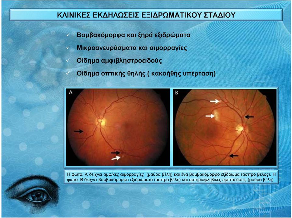 Α δείχνει αμφ/κές αιμορραγίες (μαύρα βέλη) και ένα βαμβακόμορφο εξίδρωμα (άσπρο βέλος).