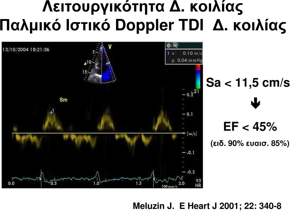 κοιλίας Sa < 11,5 cm/s EF < 45% (ειδ.