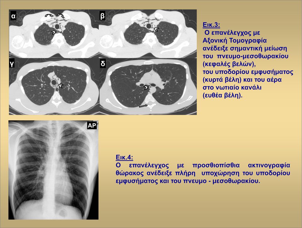πνευμο-μεσοθωρακίου (κεφαλές ελών), του υποδορίου εμφυσήματος (κυρτά έλη) και του