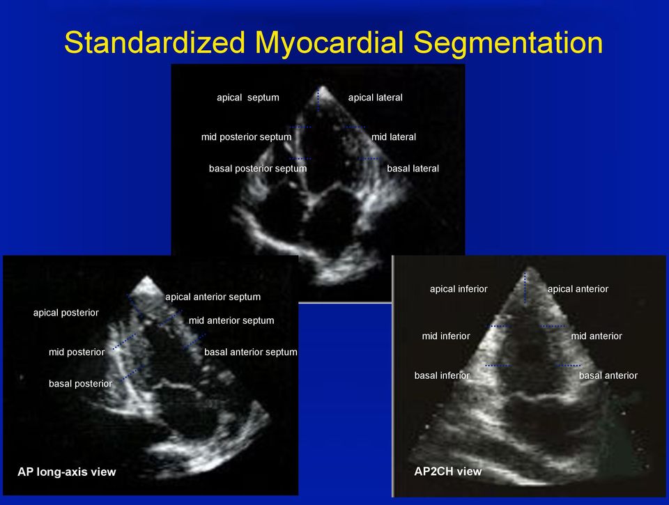 AP4CH view apical anterior septum mid anterior septum basal anterior septum apical inferior