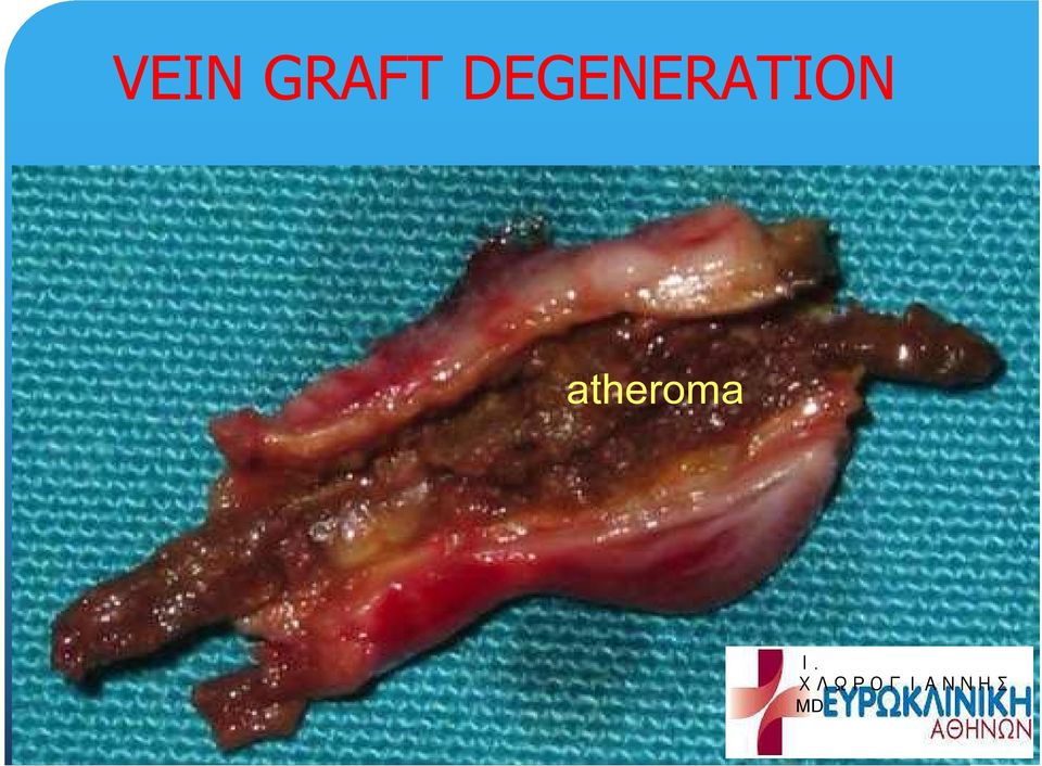 atheroma Ι.