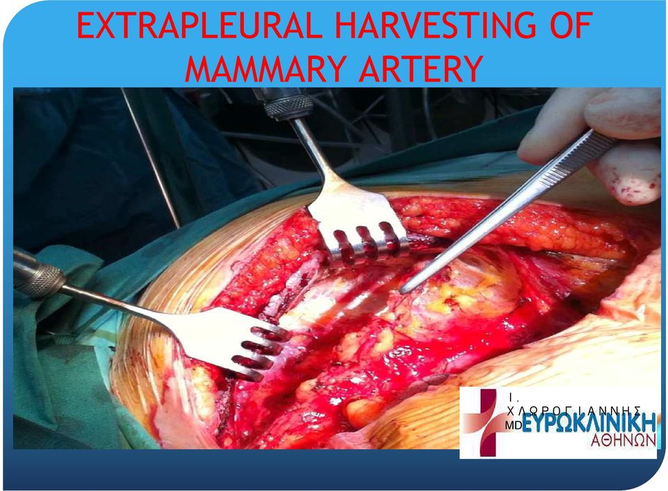 MAMMARY ARTERY