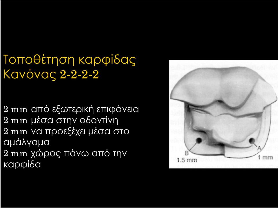 στην οδοντίνη 2 mm να προεξέχει μέσα