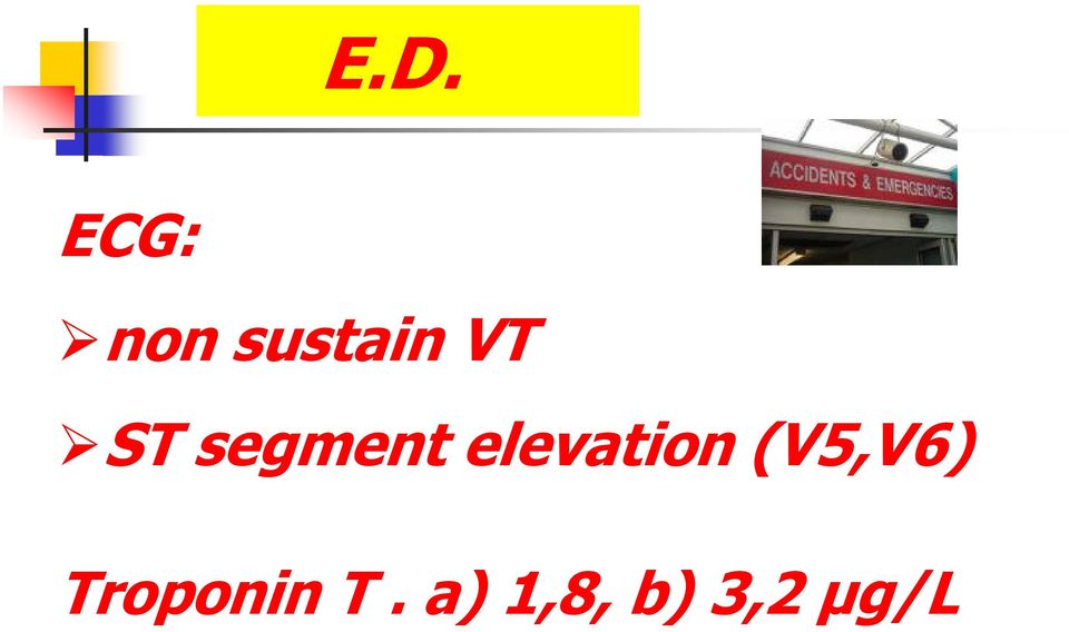 elevation (V5,V6)