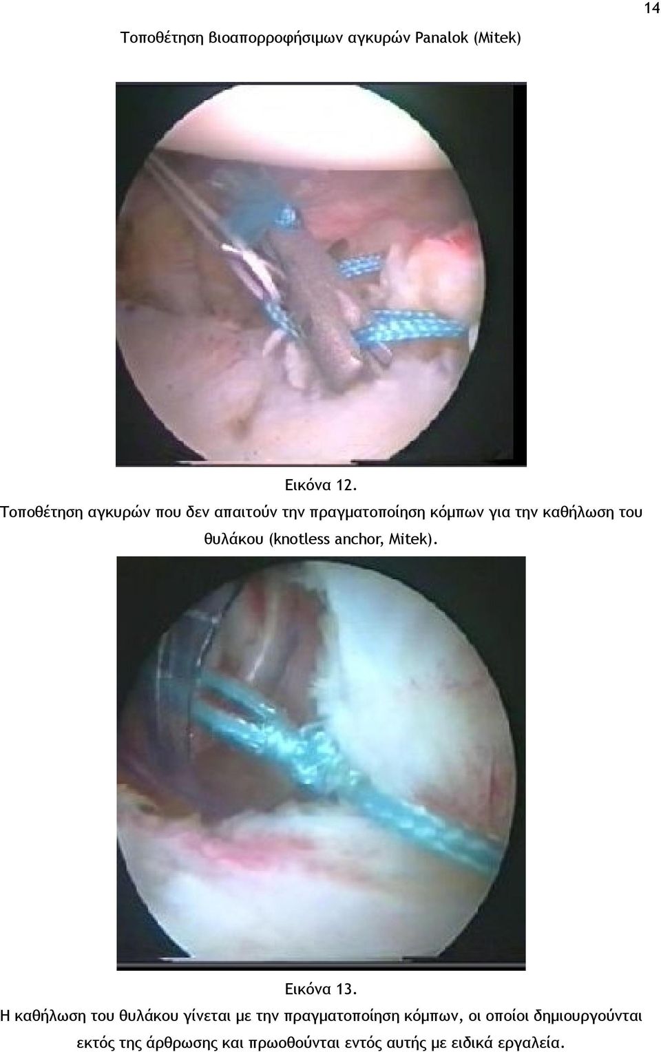 θυλάκου (knotless anchor, Mitek). Εικόνα 13.