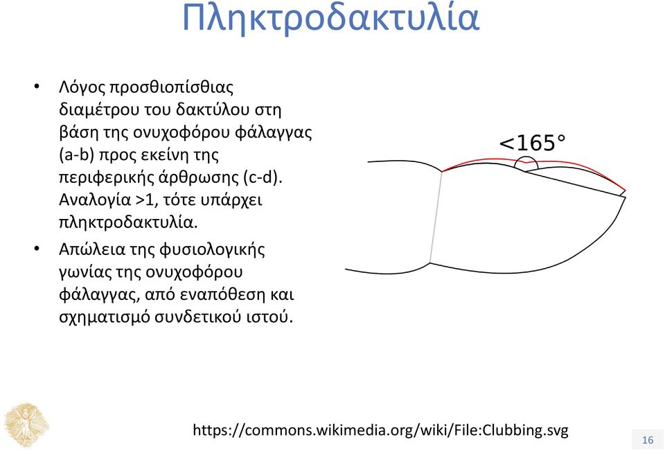 Αναλογία >1, τότε υπάρχει πληκτροδακτυλία.