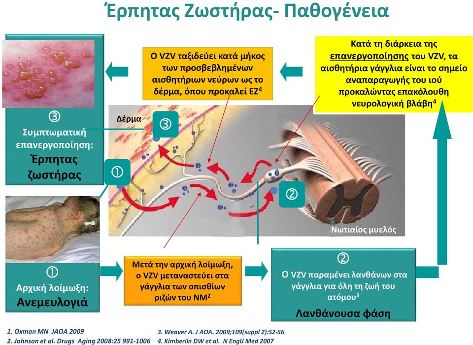 Αρχική λοίμωξη: Ανεμευλογιά Μετά την αρχική λοίμωξη, ο VZV μεταναστεύει στα γάγγλια των οπισθίων ριζών του ΝΜ2 Ο VZV παραμένει λανθάνων στα 1. Oxman MN JAOA 2009 3.