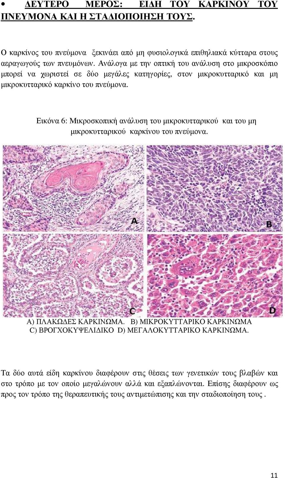 Εικόνα 6: Μικροσκοπική ανάλυση του μικροκυτταρικού και του μη μικροκυτταρικού καρκίνου του πνεύμονα. Α) ΠΛΑΚΩΔΕΣ ΚΑΡΚΙΝΩΜΑ.