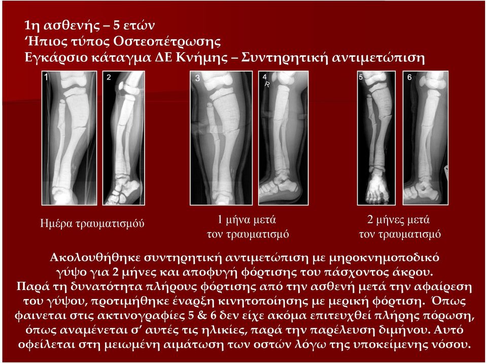 Παρά τη δυνατότητα πλήρους φόρτισης από την ασθενή μετά την αφαίρεση του γύψου, προτιμήθηκε έναρξη κινητοποίησης με μερική φόρτιση.