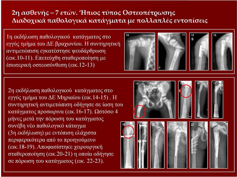 12-13) 2η εκδήλωση παθολογικού κατάγματος στο εγγύς τμήμα του ΔΕ Μηριαίου (εικ.14-15). Η συντηρητική αντιμετώπιση οδήγησε σε ίαση του κατάγματος προσωρινα (εικ.16-17).