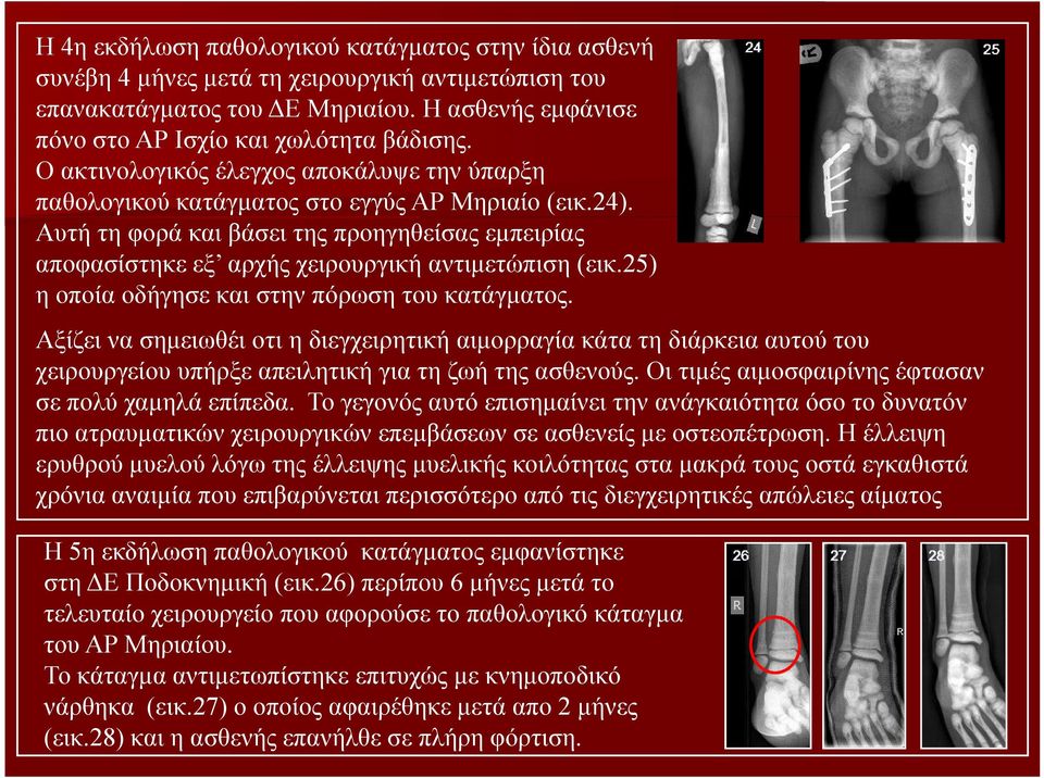 Αυτή τη φορά και βάσει της προηγηθείσας εμπειρίας αποφασίστηκε εξ αρχής χειρουργική αντιμετώπιση (εικ.25) η οποία οδήγησε και στην πόρωση του κατάγματος.