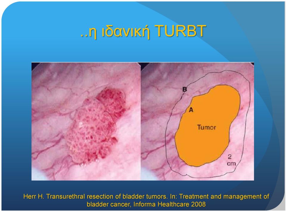 tumors.