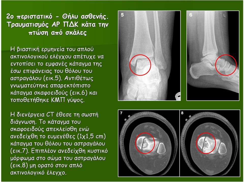 έσω επιφάνειας του θόλου του αστραγάλου (εικ.5). Αντιθέτως γνωµατεύτηκε απαρεκτόπιστο κάταγµα σκαφοειδούς (εικ.6) και τοποθετήθηκε ΚΜΠ γύψος.