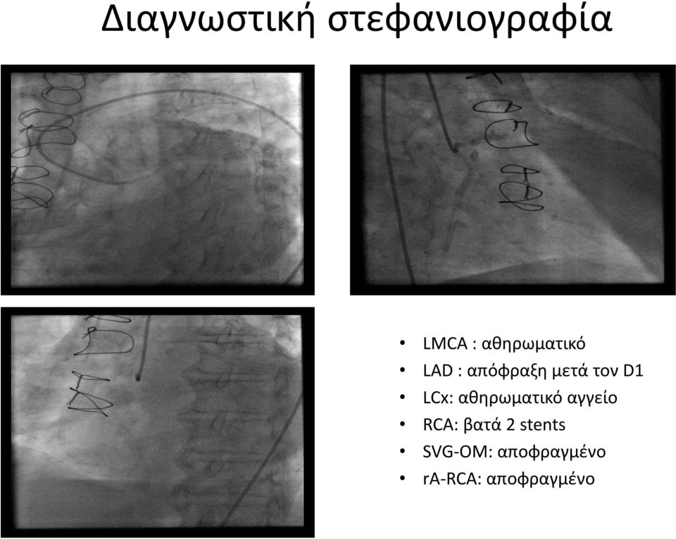 LCx: ακθρωματικό αγγείο RCA: βατά 2