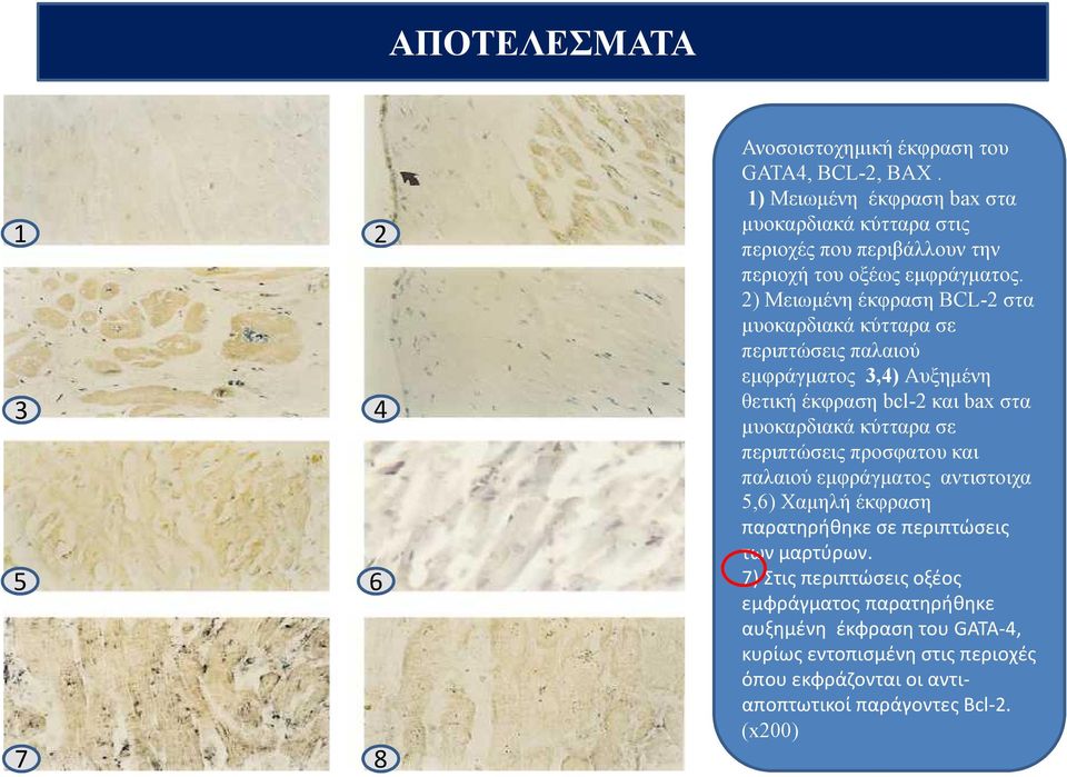 2) Μειωμένη έκφραση BCL-2 στα μυοκαρδιακά κύτταρα σε περιπτώσεις παλαιού εμφράγματος 3,4) Αυξημένη θετική έκφραση bcl-2 και bax στα μυοκαρδιακά κύτταρα σε