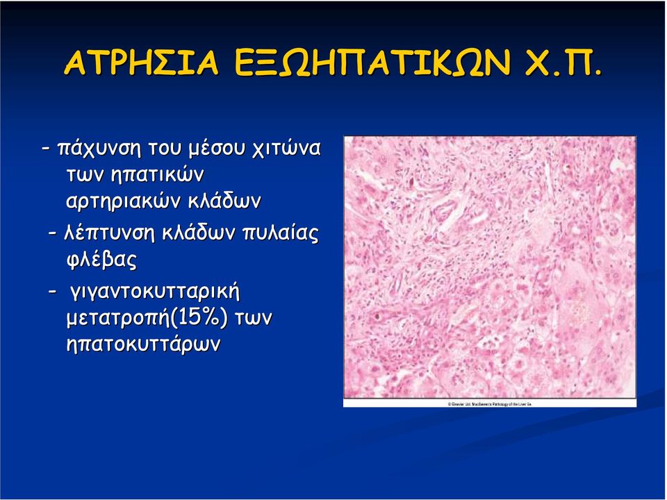 - πάχυνση του µέσου χιτώνα των ηπατικών