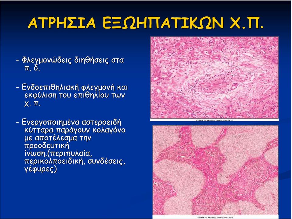 - Ενδοεπιθηλιακή φλεγµονή και εκφύλιση του επιθηλίου των χ. π.