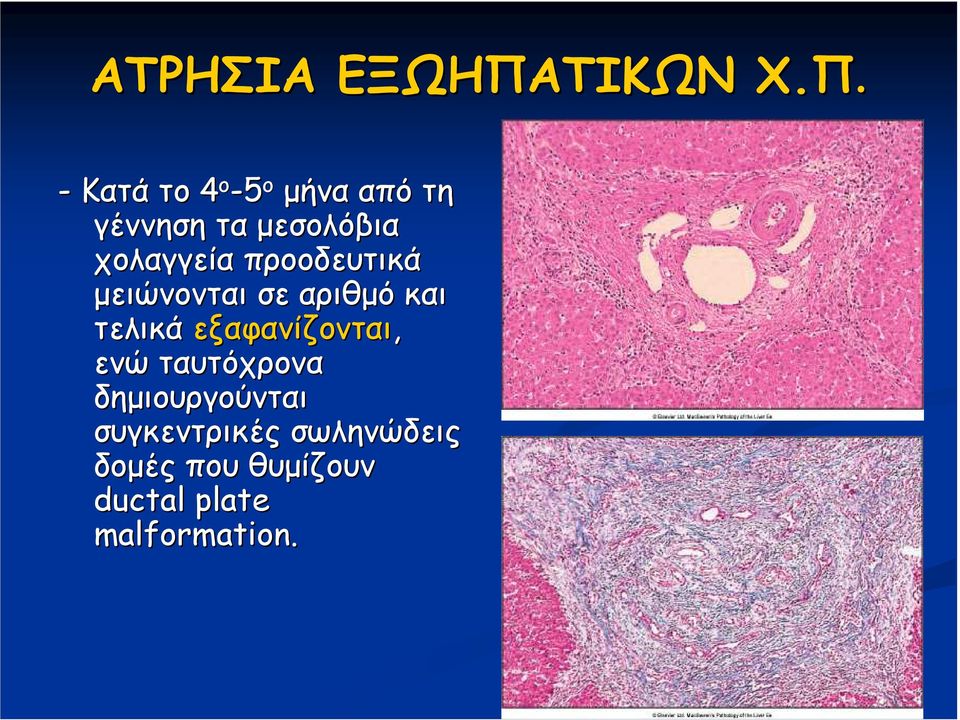 - Κατά το 4 ο -5 ο µήνα από τη γέννηση τα µεσολόβια χολαγγεία