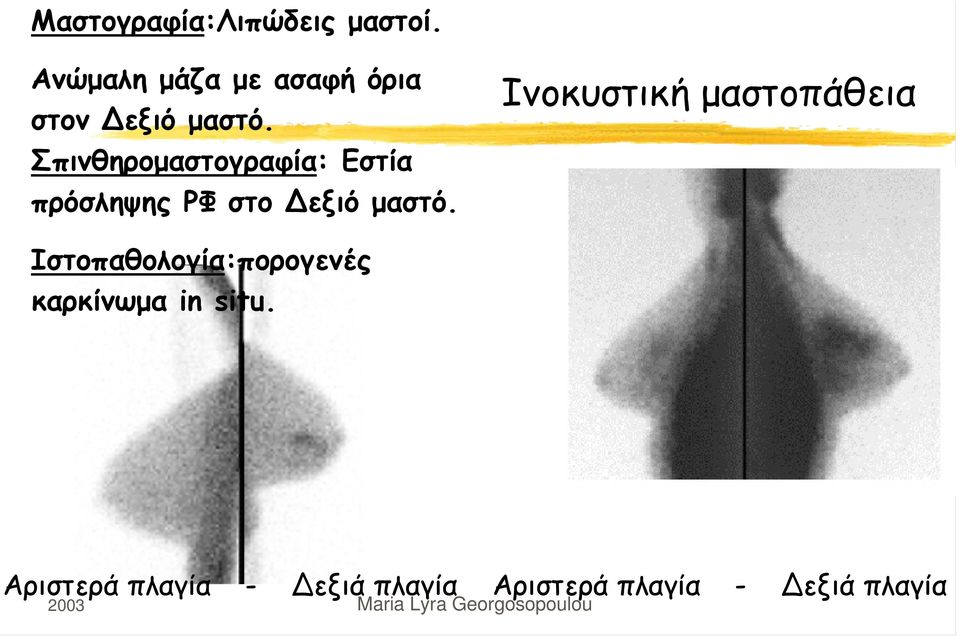 Σπινθηρομαστογραφία: Εστία πρόσληψης ΡΦ στο εξιό μαστό.