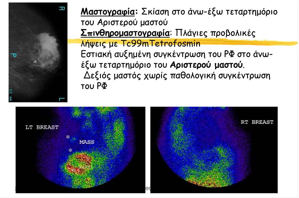 Εστιακή αυξημένη συγκέντρωση του ΡΦ στο άνωέξω τεταρτημόριο του