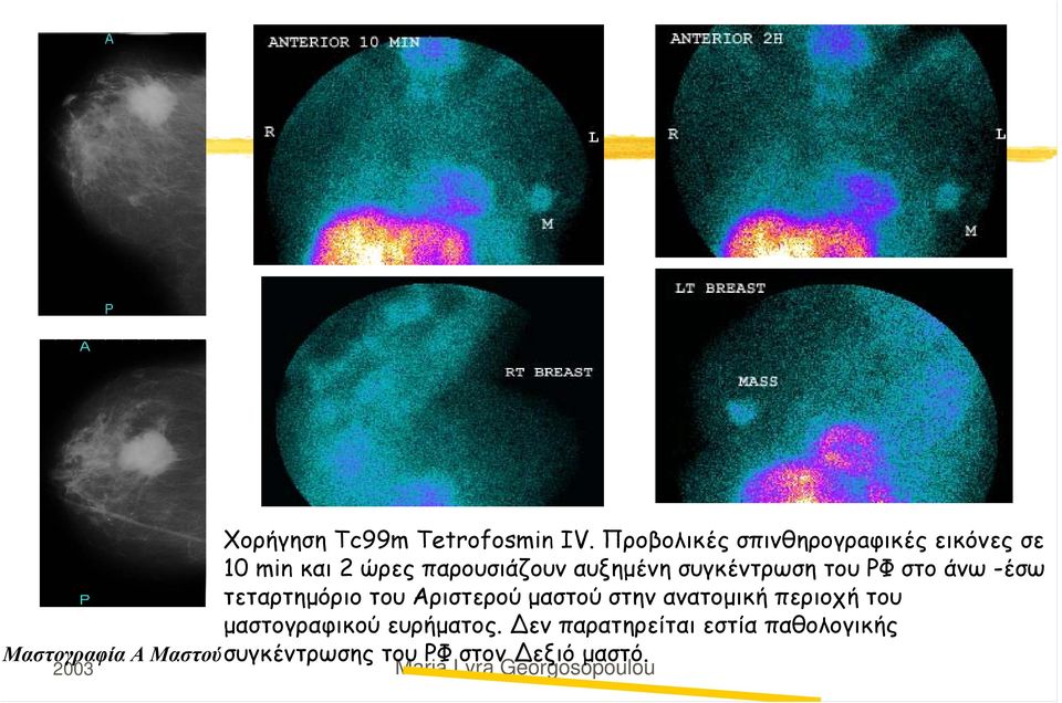 συγκέντρωση του ΡΦ στο άνω -έσω τεταρτημόριο του Αριστερού μαστού στην