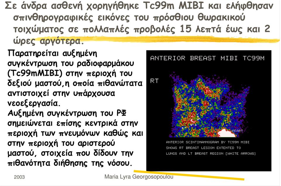 Παρατηρείται αυξημένη συγκέντρωση του ραδιοφαρμάκου (Tc99mMIBI) στην περιοχή του δεξιού μαστού,η οποία πιθανώτατα αντιστοιχεί