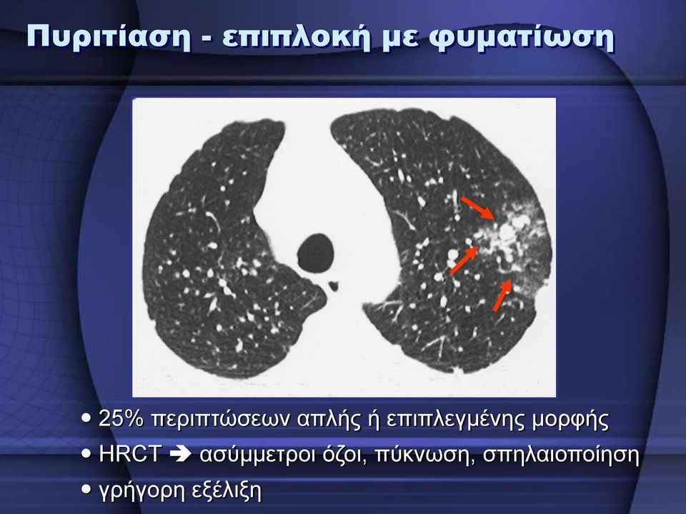 επηπιεγκέλεο κνξθήο HRCT