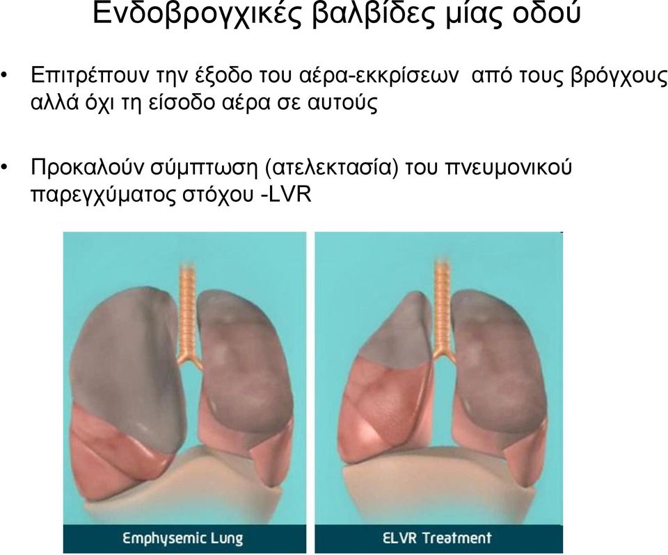 όρη ηε είζνδν αέξα ζε απηνύο Πξνθαινύλ ζύκπησζε