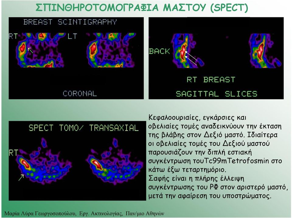 Ιδιαίτερα οι οβελιαίες τομές του εξιού μαστού παρουσιάζουν την διπλή εστιακή συγκέντρωση