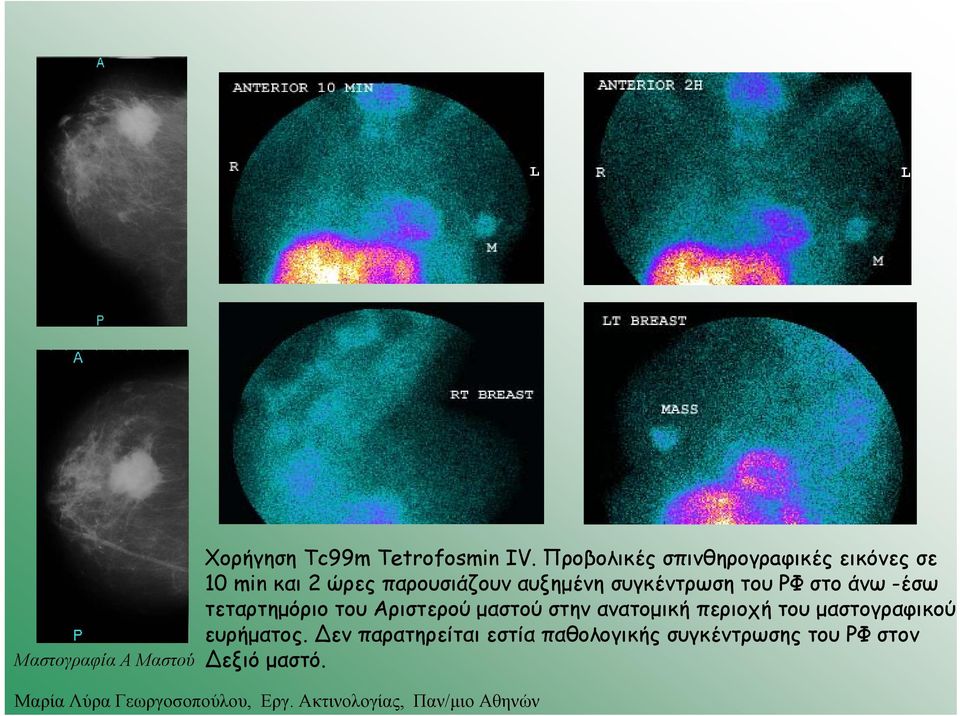 συγκέντρωση του ΡΦ στο άνω -έσω τεταρτημόριο του Αριστερού μαστού στην