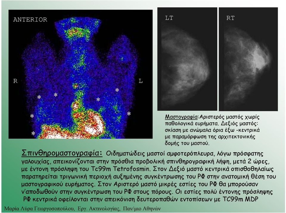 Tetrofosmin. Στον εξιό μαστό κεντρικά οπισθοθηλαίως παρατηρείται τριγωνική περιοχή αυξημένης συγκέντρωσης του ΡΦ στην ανατομική θέση του μαστογραφικού ευρήματος.