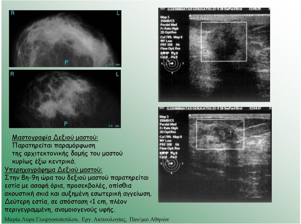 Υπερηχογράφημα εξιού μαστού: Στην 8η-9η ώρατουδεξιούμαστούπαρατηρείται εστία με ασαφή