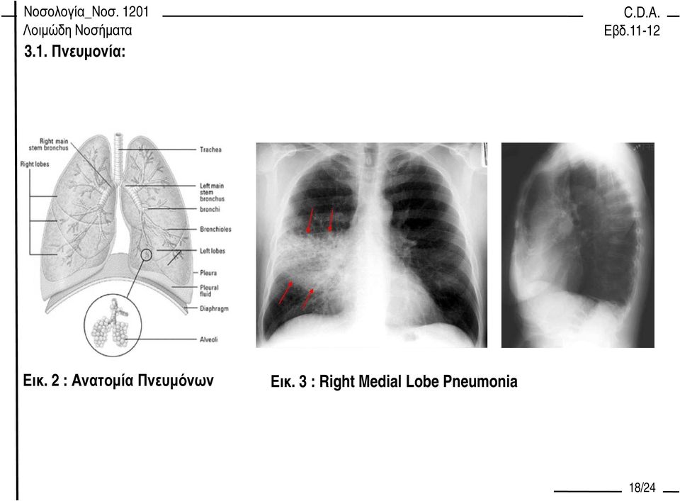 Πνευµόνων Εικ.