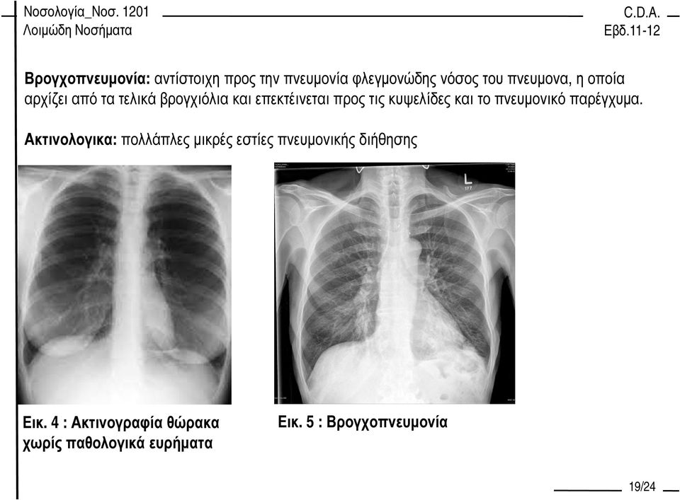 πνευµονικό παρέγχυµα.