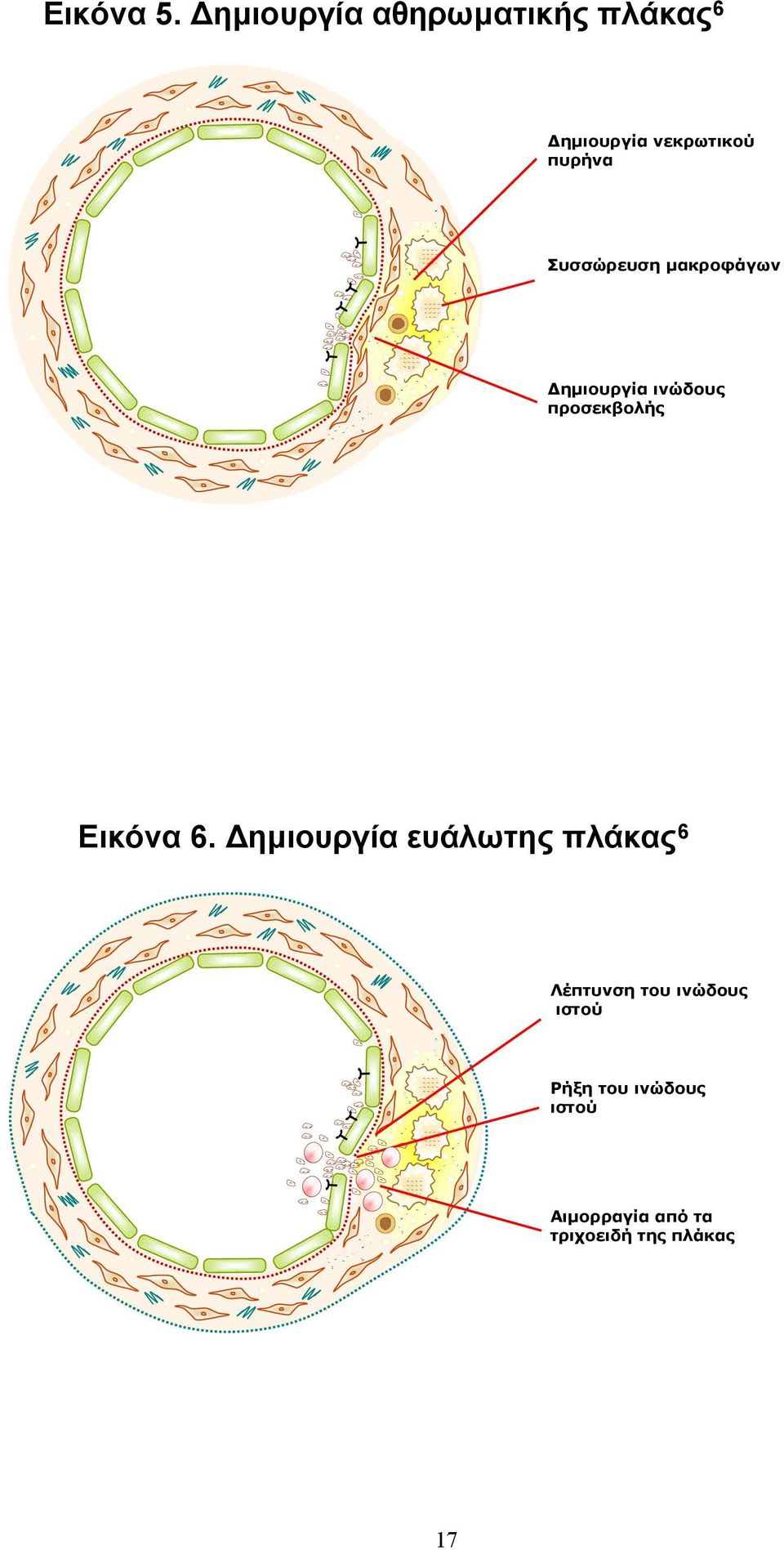 Συσσώρευση µακροφάγων ηµιουργία ινώδους προσεκβολής Εικόνα 6.