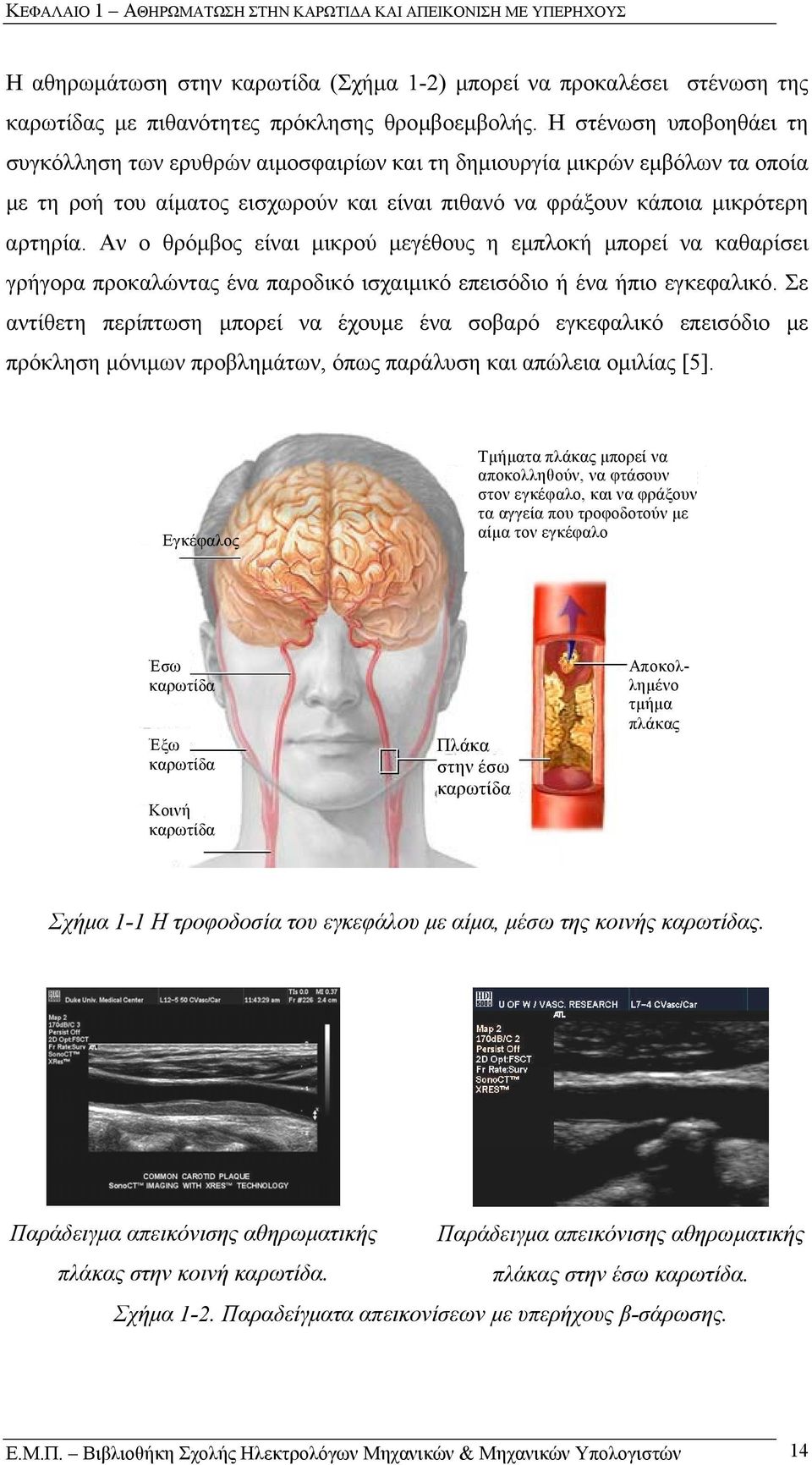 Αν ο θρόµβος είναι µικρού µεγέθους η εµπλοκή µπορεί να καθαρίσει γρήγορα προκαλώντας ένα παροδικό ισχαιµικό επεισόδιο ή ένα ήπιο εγκεφαλικό.