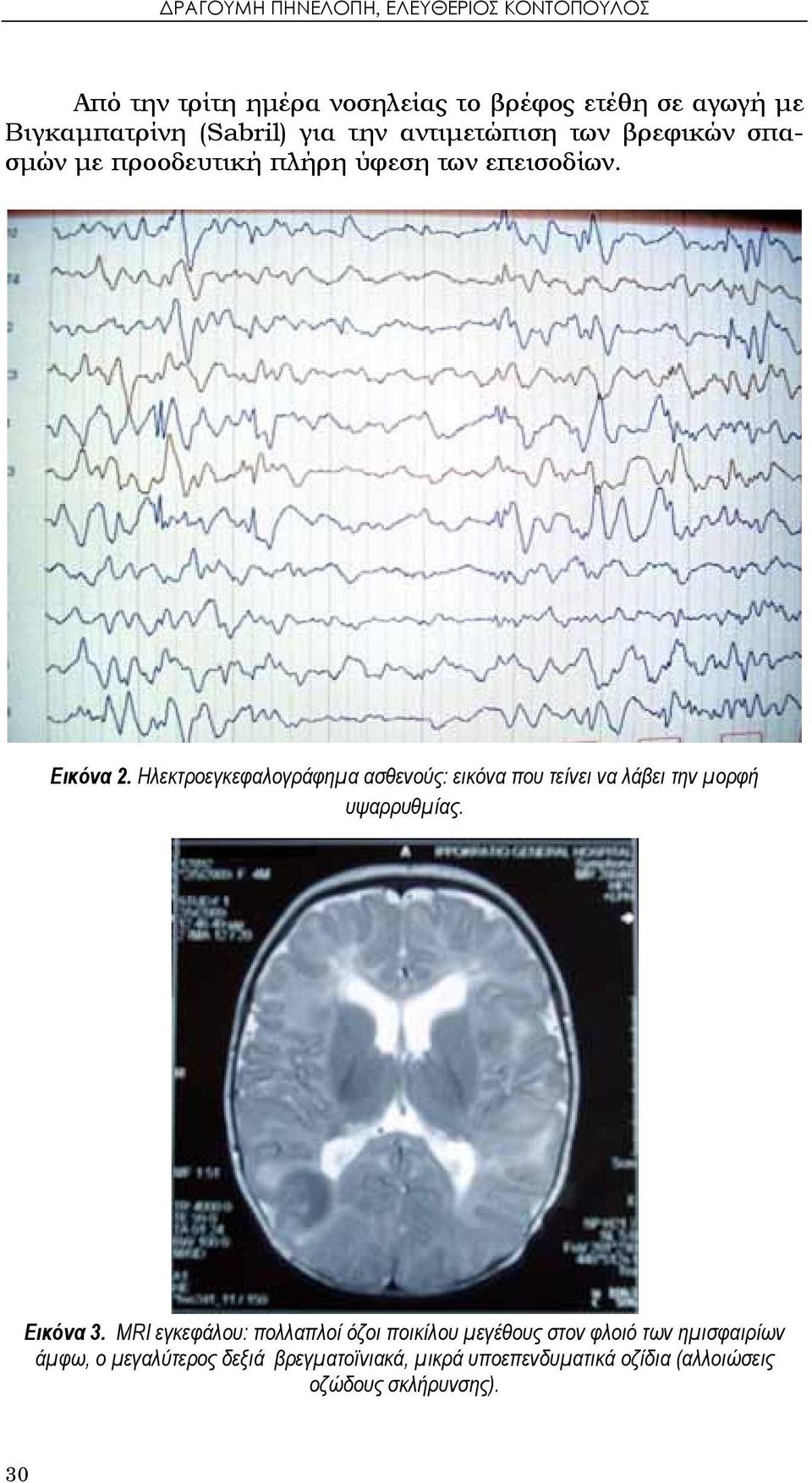Ηλεκτροεγκεφαλογράφημα ασθενούς: εικόνα που τείνει να λάβει την μορφή υψαρρυθμίας. Εικόνα 3.